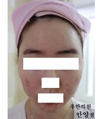 안양점 치료 전
