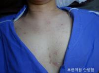 안양점 치료 전
