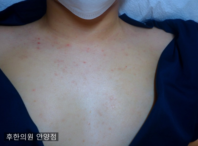 안양점 치료 전