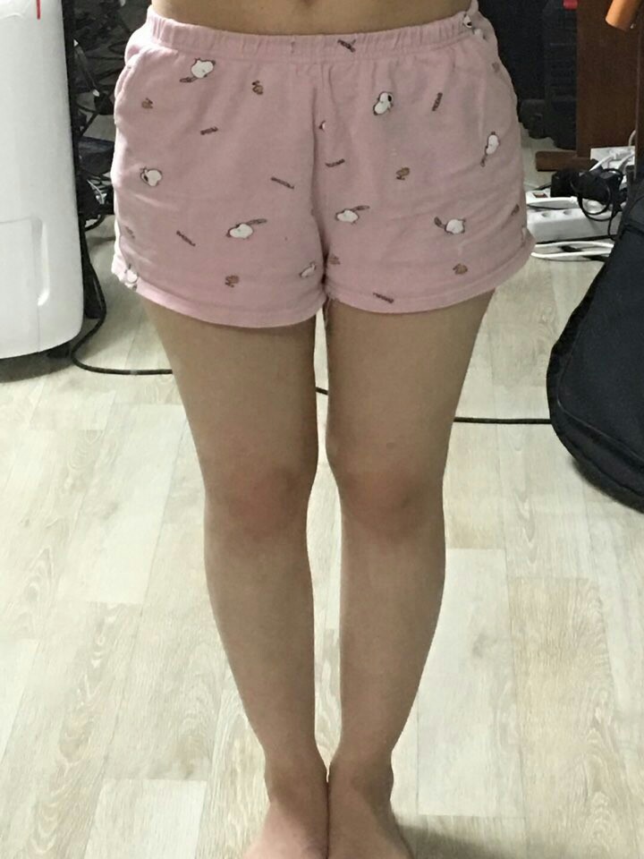 안양점 치료 전