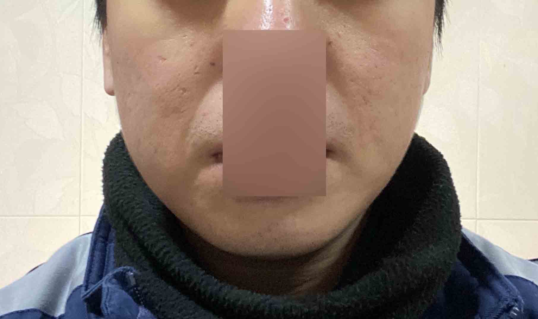 안양점 치료 후