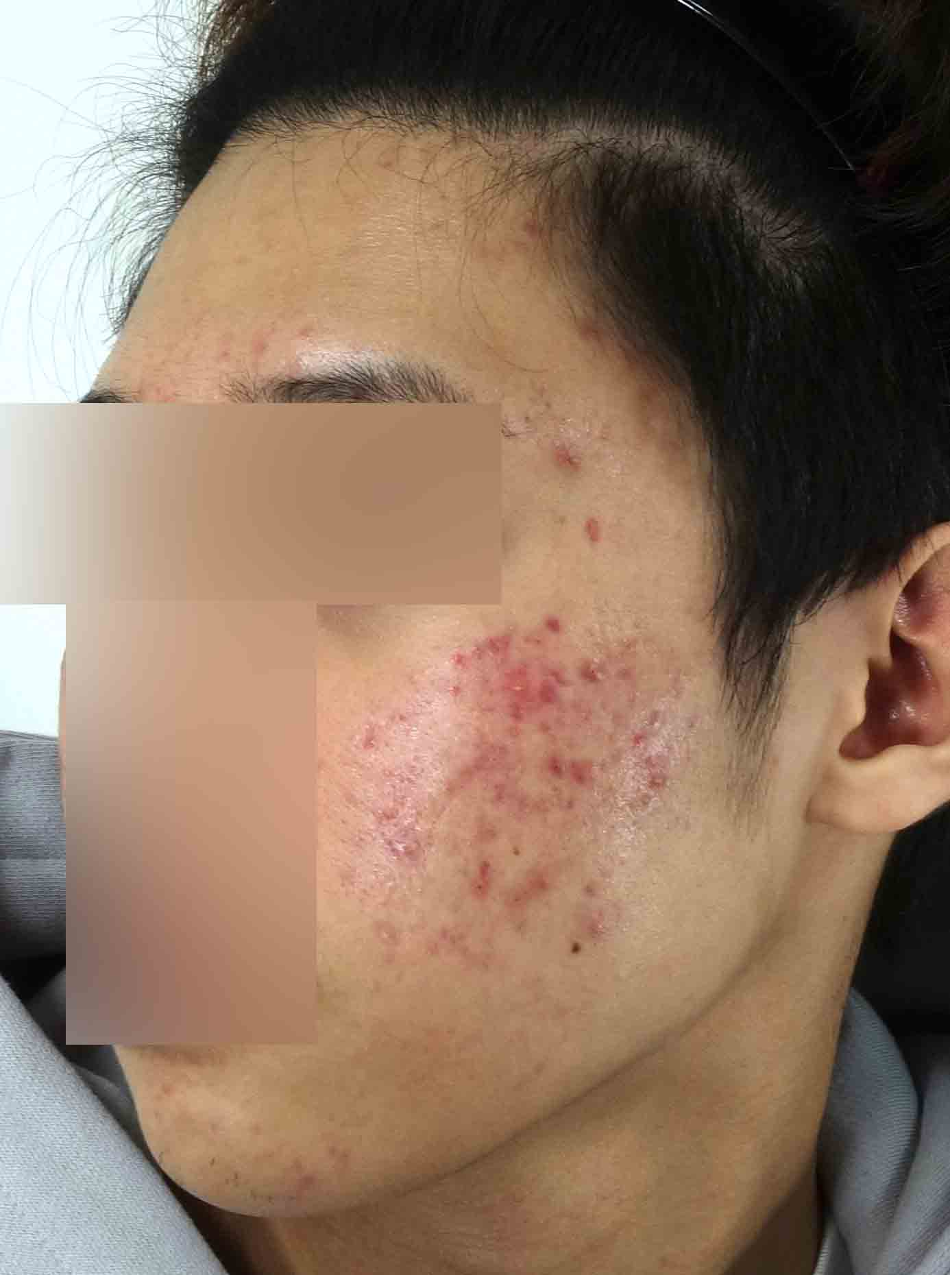 안양점 치료 전